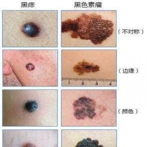 黑色素瘤再上热搜，专家教您初步识别“癌中之王”