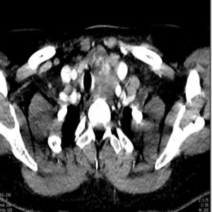 声乐老师喉咙不适，检查后竟发现巨大甲状腺肿瘤